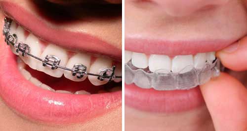 aligners