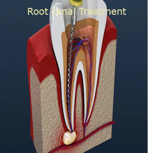 root canal